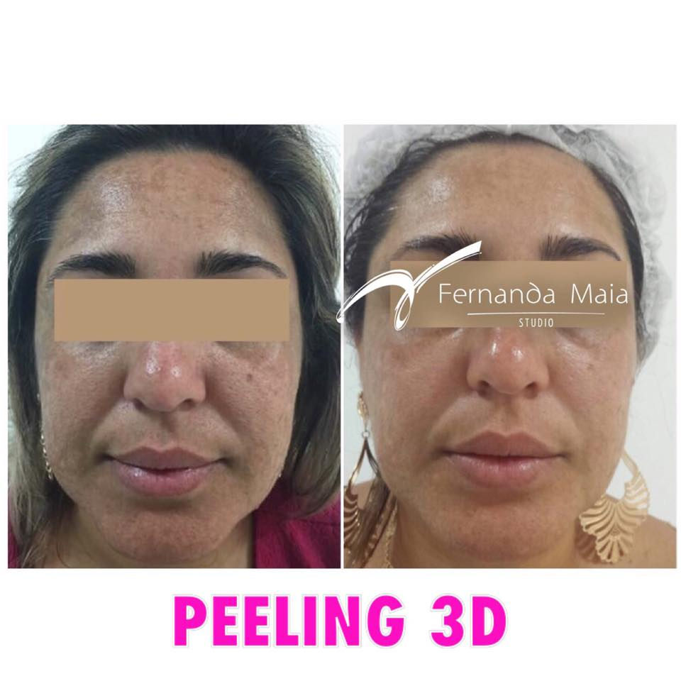 Resultado do 1º ciclo de Peeling 3D