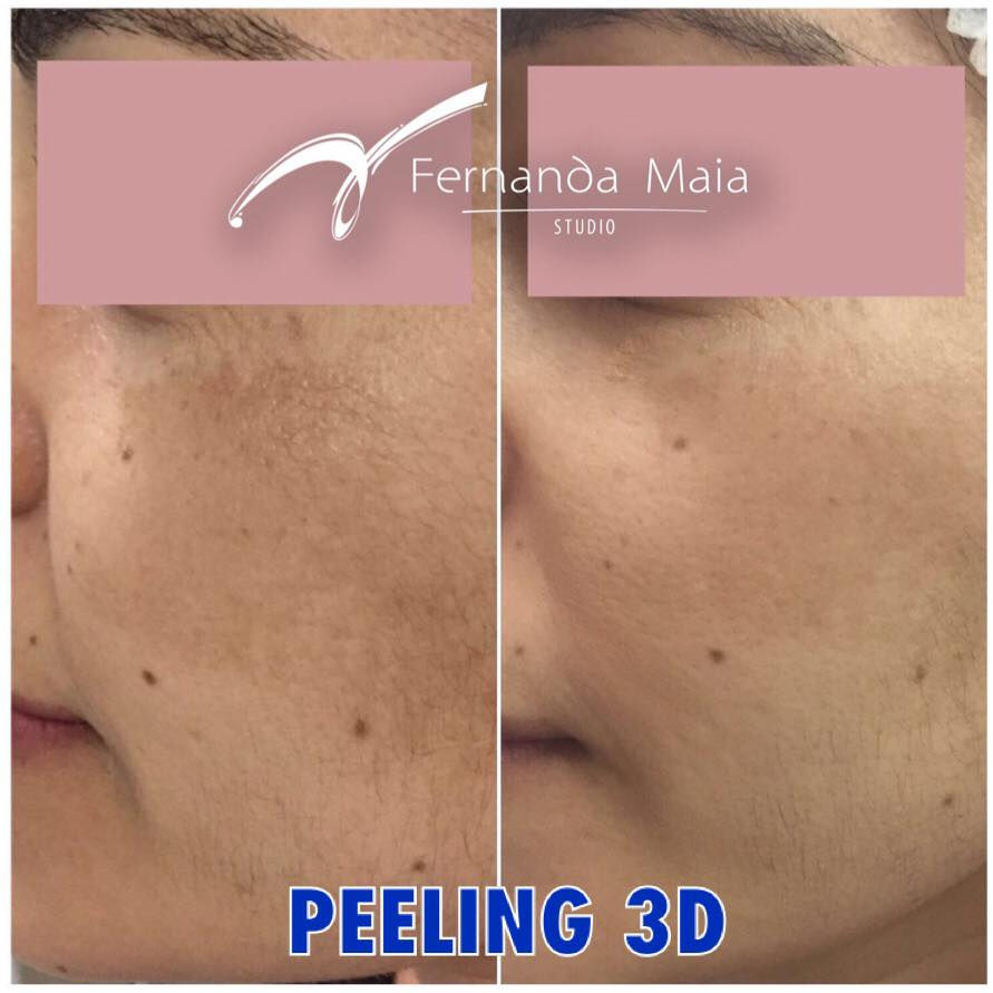 Resultado de Peeling 3D. Cliente ainda em tratamento