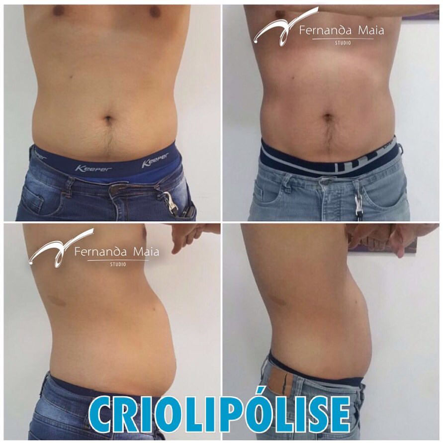 Criolipólise - resultado de 45 dias