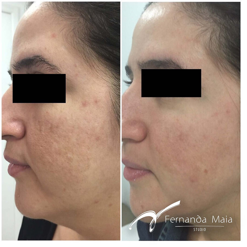 Resultado Peeling 3D