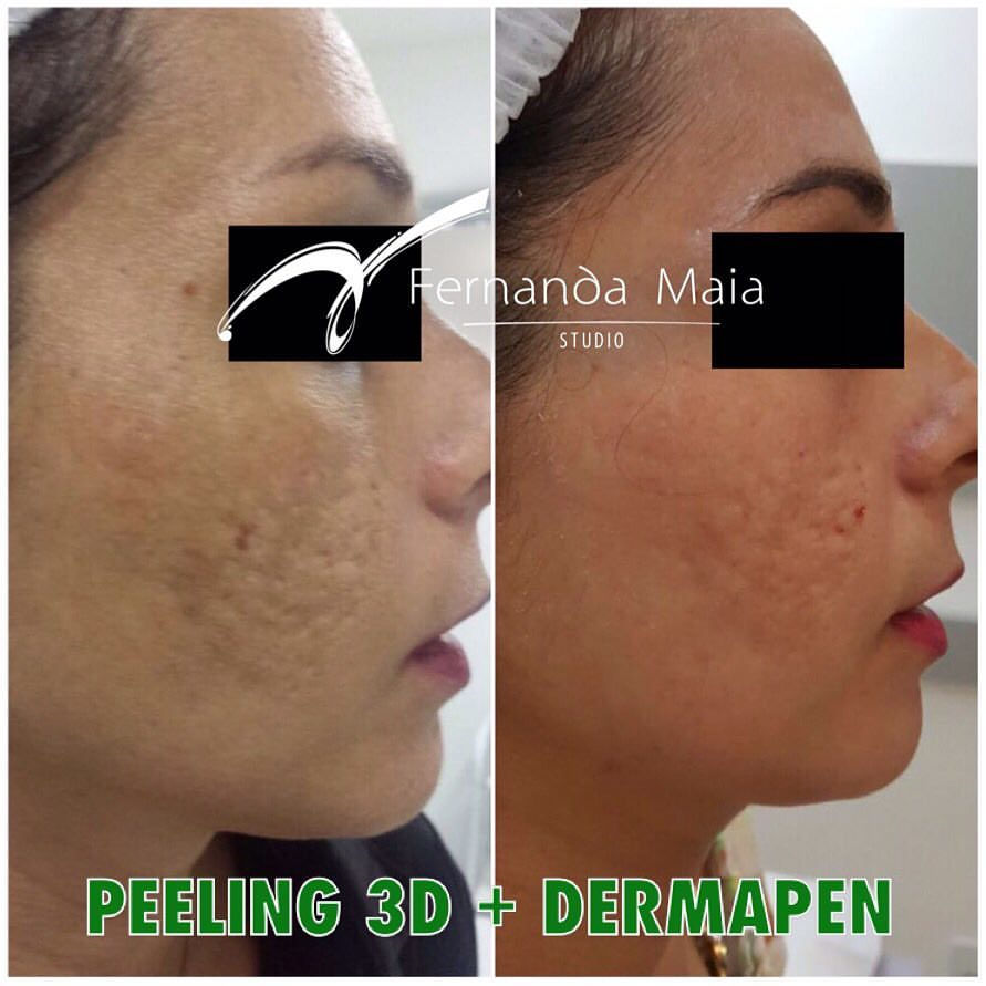 Resultado parcial do nosso tratamento Peeling 3D + Dermapen, para tratar manchas e cicatriz de acne