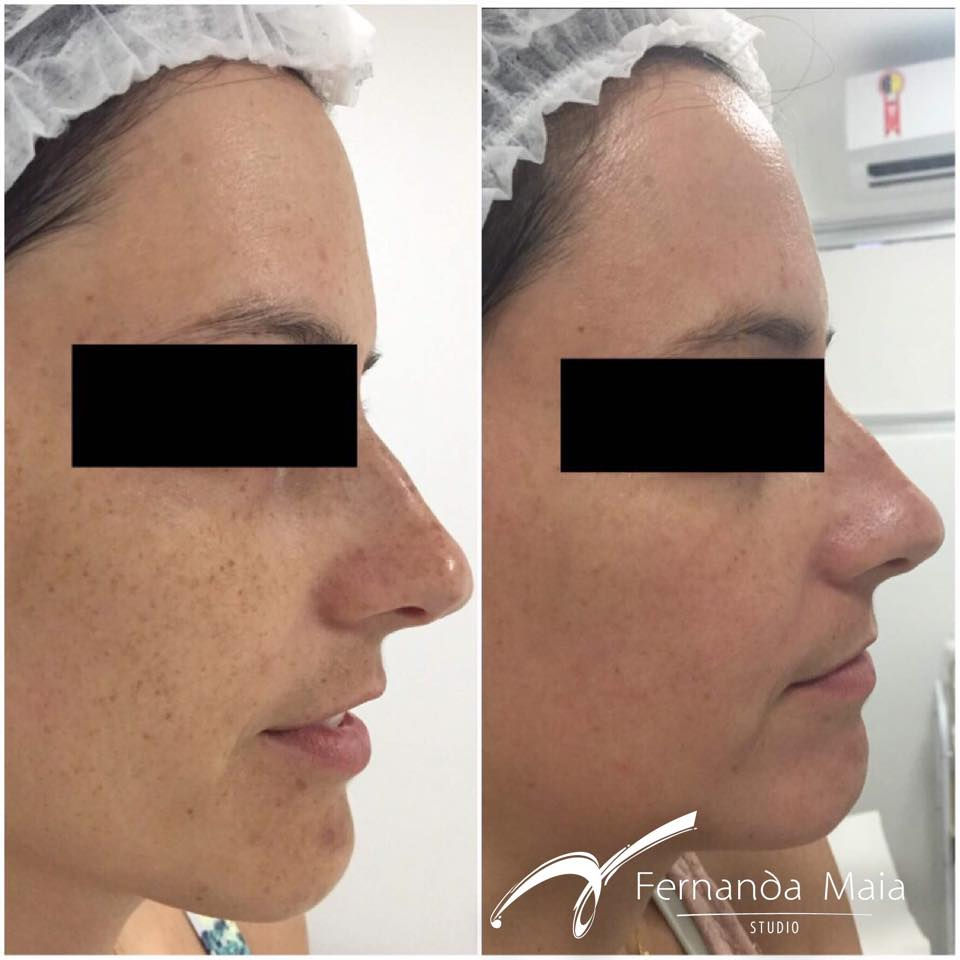Resultado de 1 ciclo de Peeling 3D