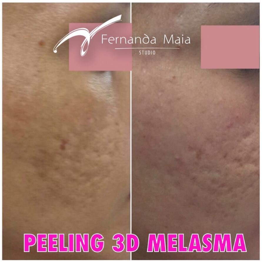 Resultado_do_1º_ciclo_de_Peeling_3D_para_tratar_melasma._Cliente_ainda_em_tratamento