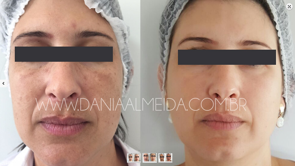 Resultado Magical Process Melasma