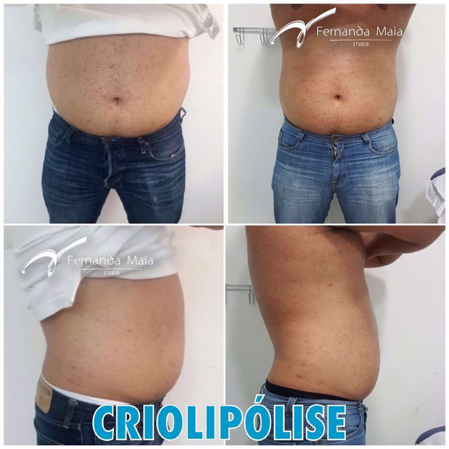 Criolipólise - resultado de 40 dias