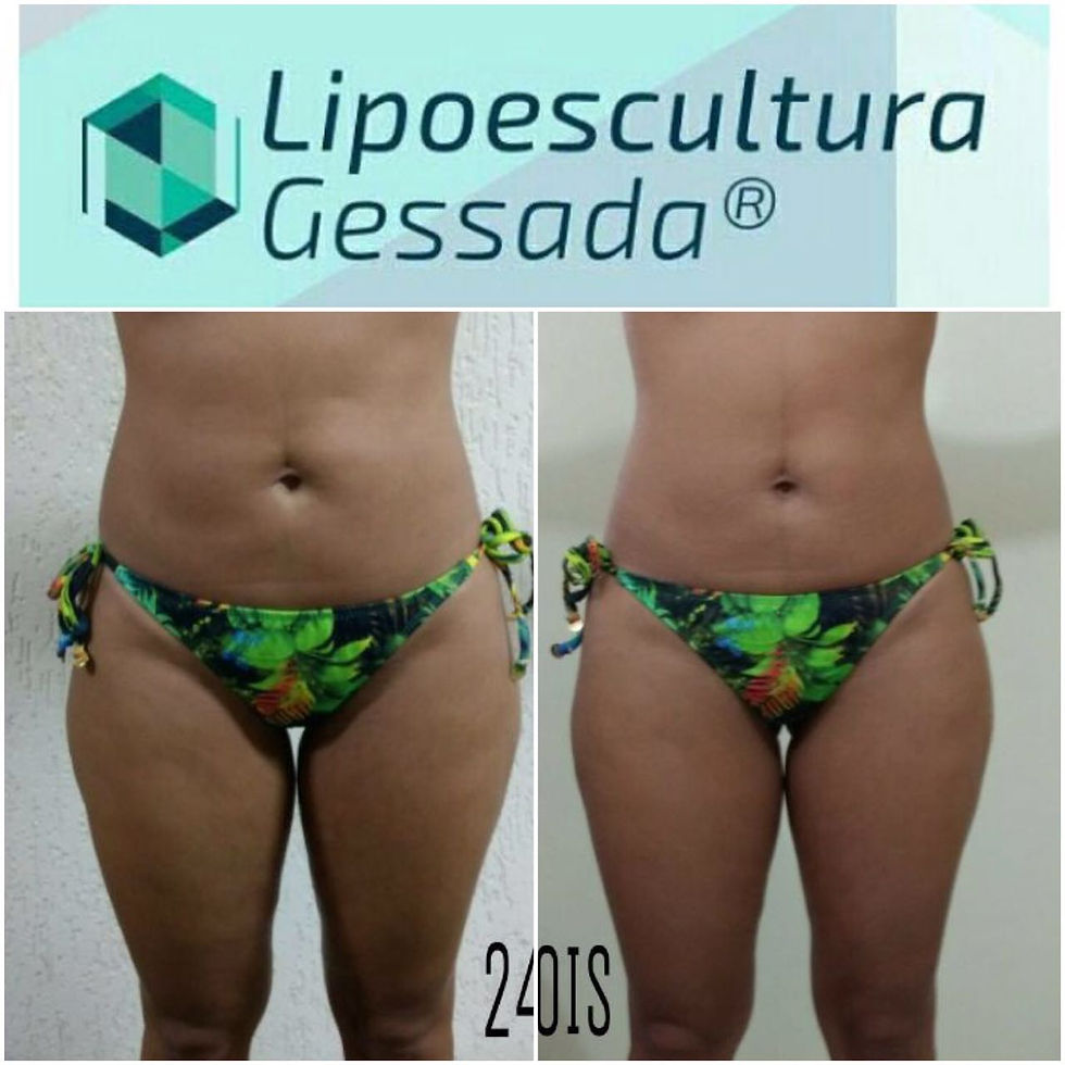 Lipoescultura Gessada