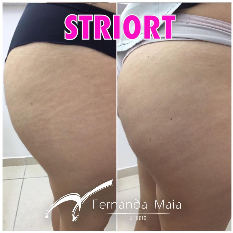 STRIORT - tratamento para estrias