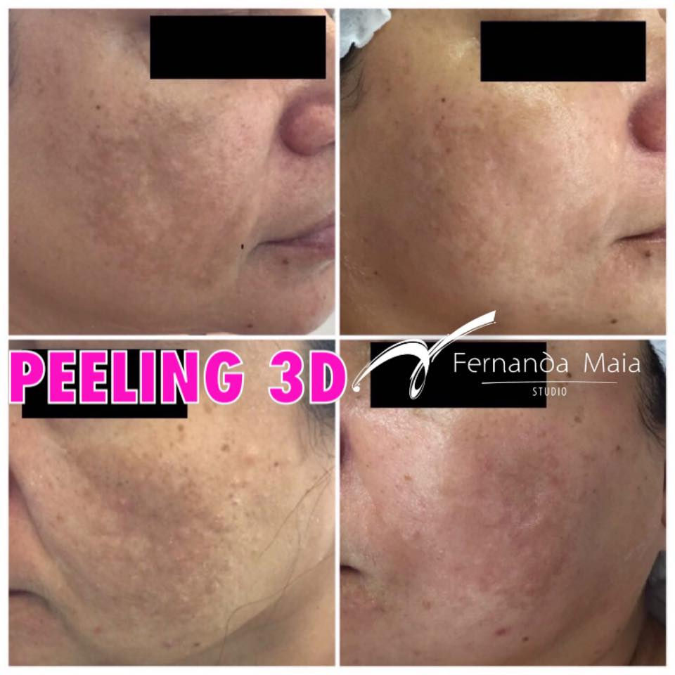 Resultado Peeling 3D