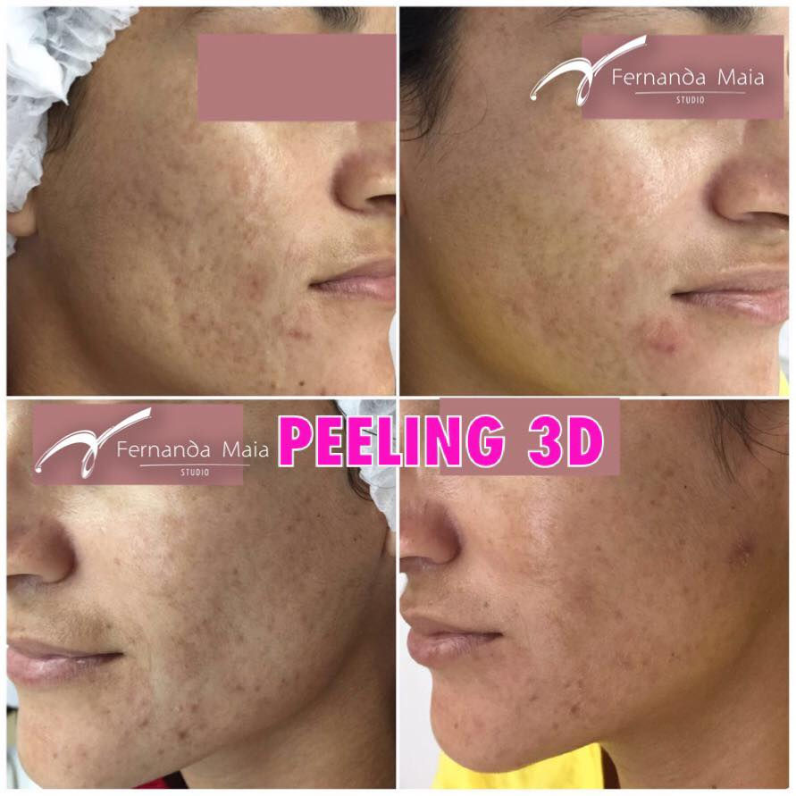 Resultado_do_1º_ciclo_de_Peeling_3D._Cliente_ainda_em_tratamento
