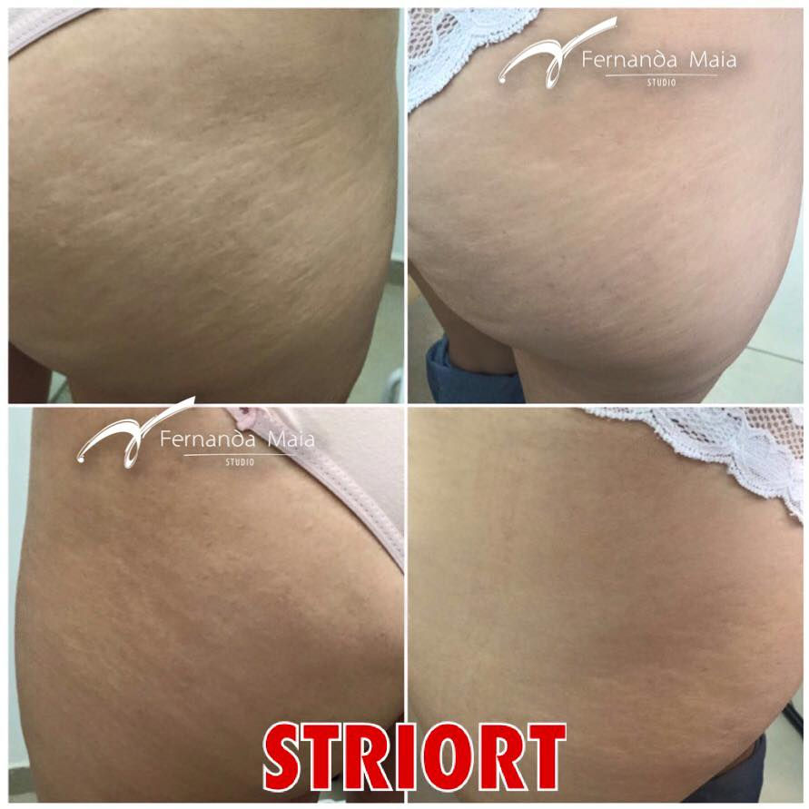 STRIORT - tratamento para estrias