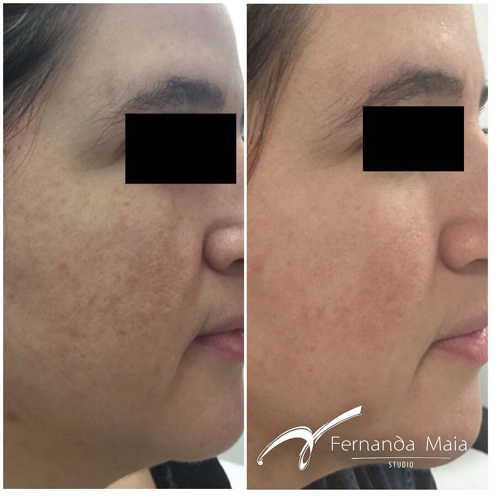 Resultado Peeling 3D