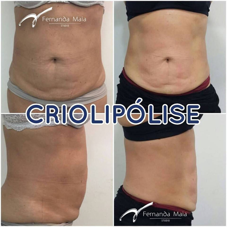 Criolipólise #cooltech - resultado