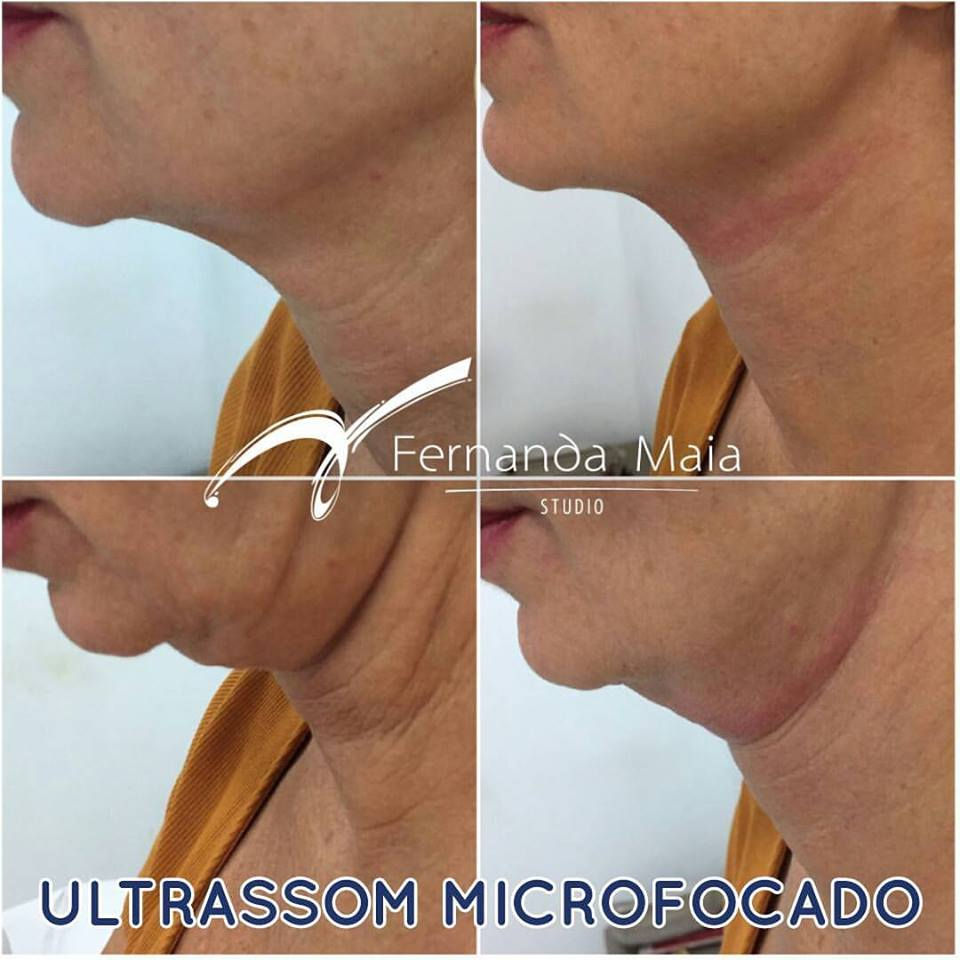 Ultrassom Microfocado Vithara