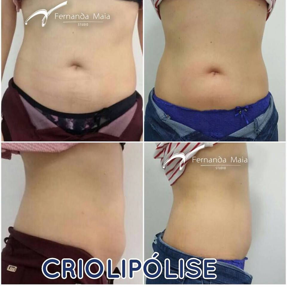 Criolipólise #cooltech - resultado