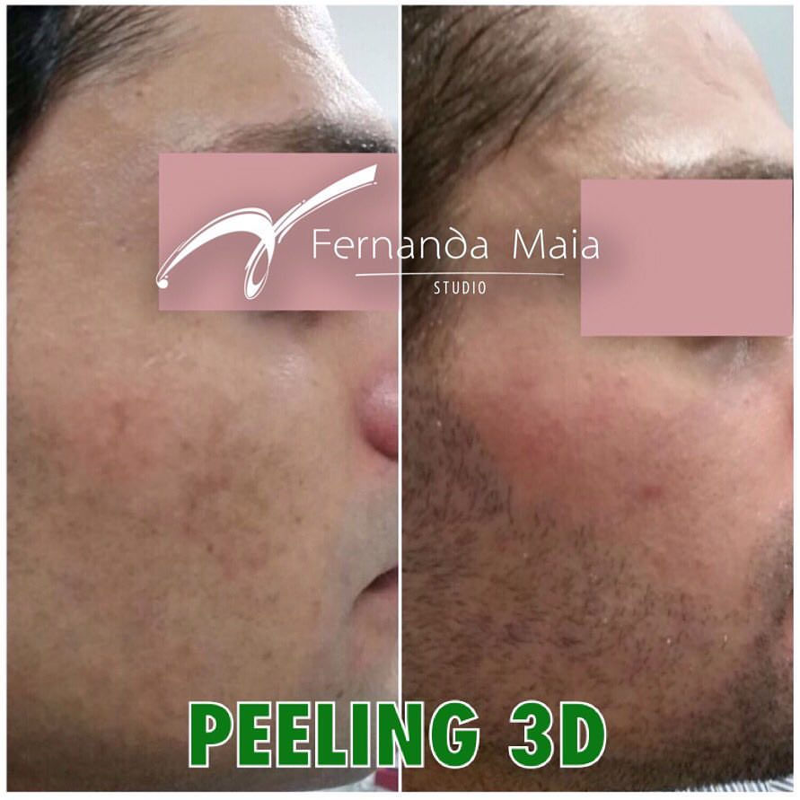 Resultado de 1 ciclo peeling 3D