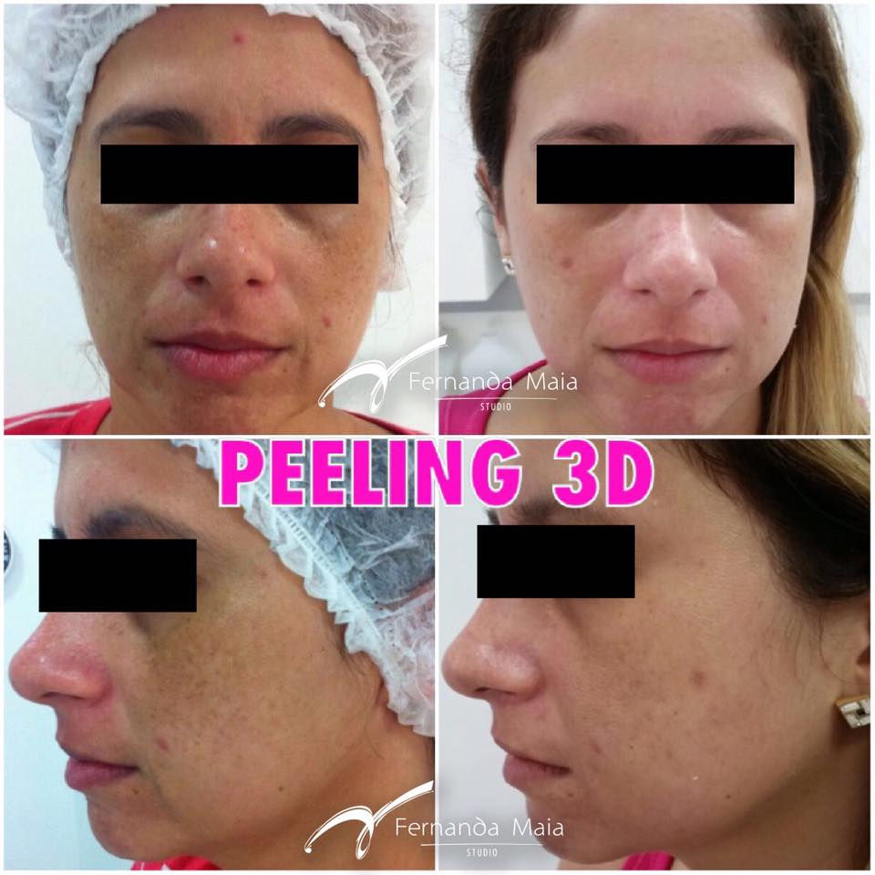 Resultado de 2 ciclos de Peeling 3D