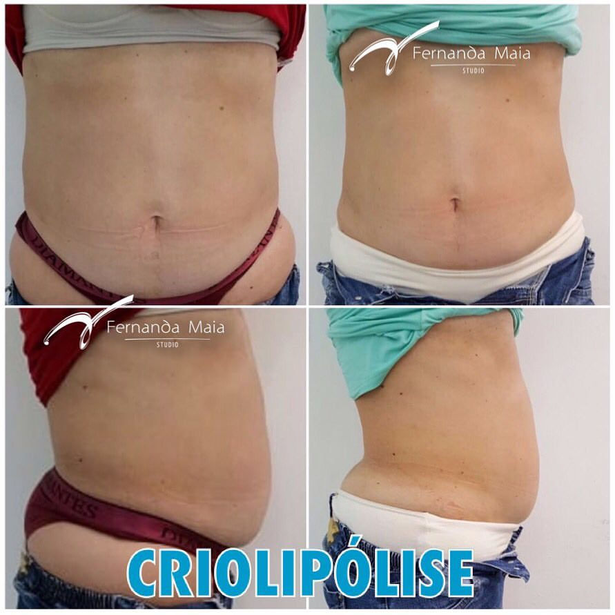 Criolipólise - resultado de 30 dias