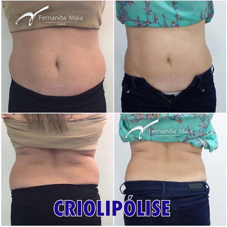 Criolipólise - resultado de 30 dias