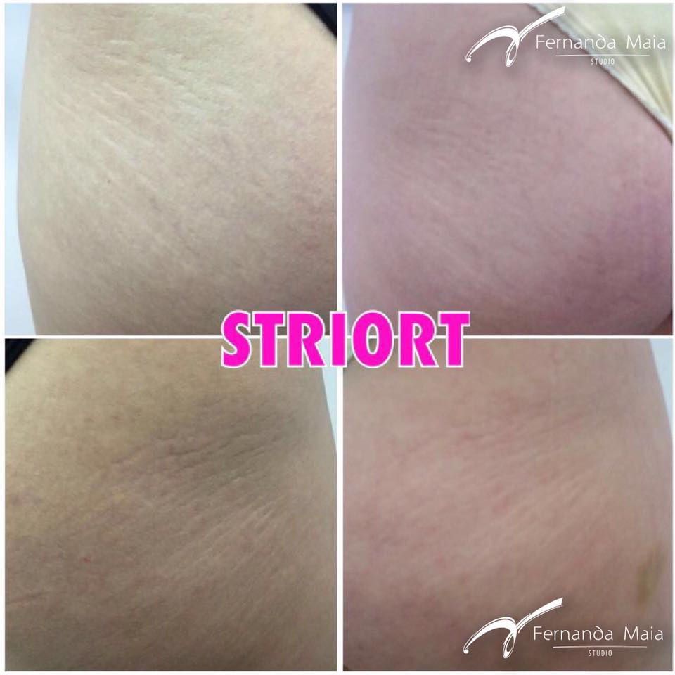 STRIORT - tratamento para estrias