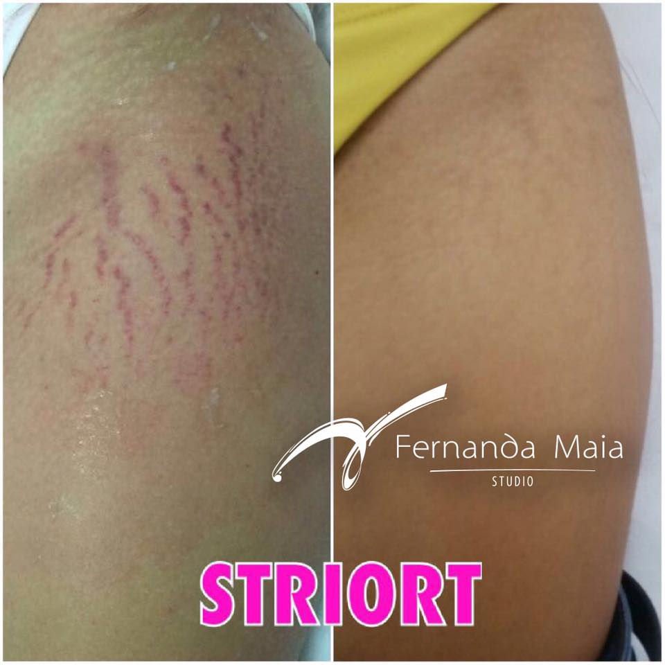 STRIORT - tratamento para estrias