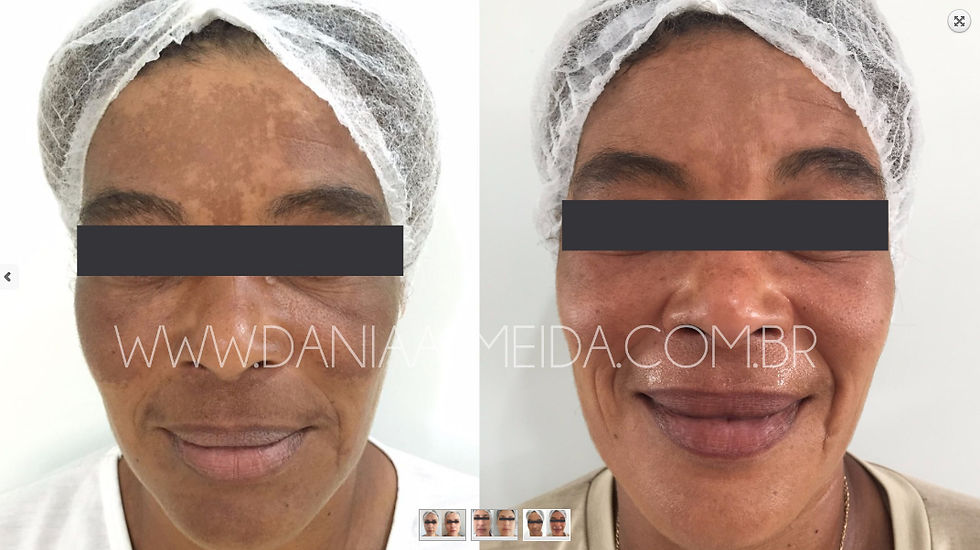 Resultado Magical Process Melasma