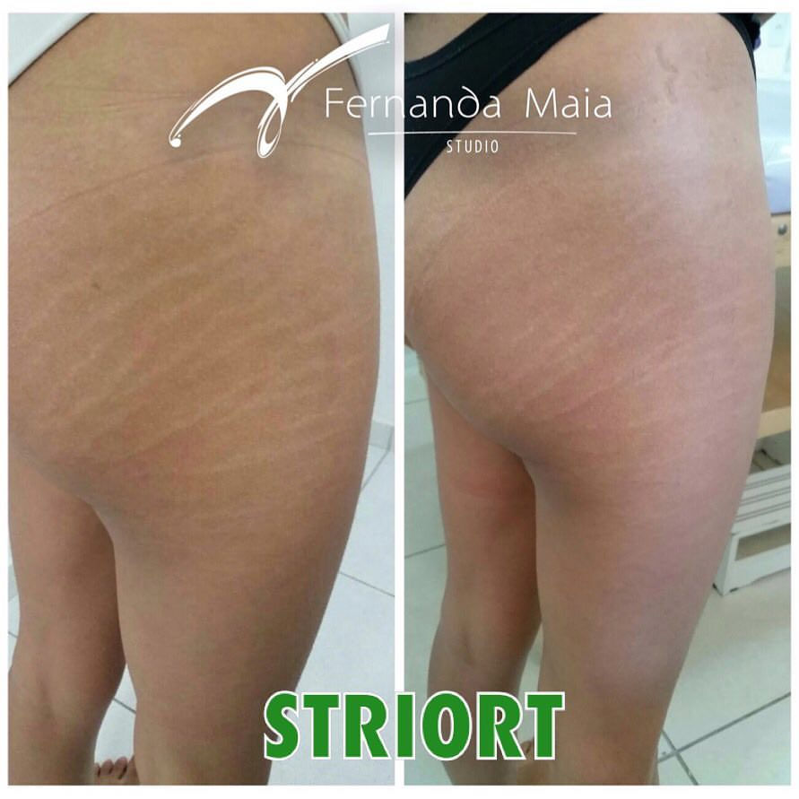 STRIORT - tratamento para estrias