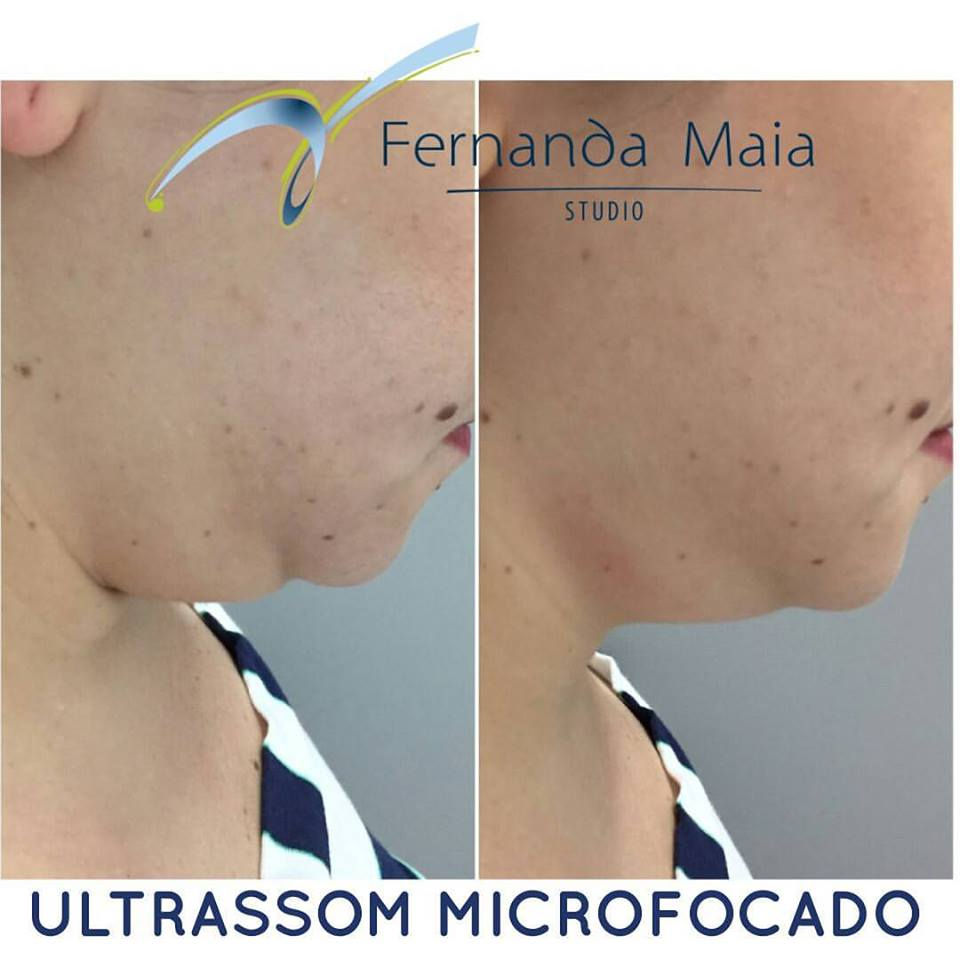 Ultrassom Microfocado Vithara