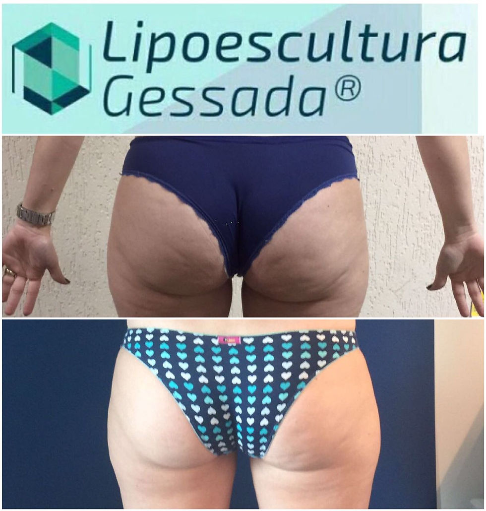 Lipoescultura Gessada