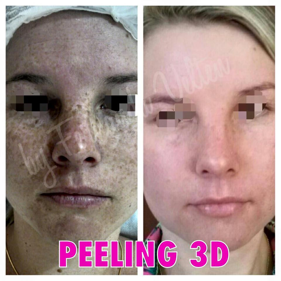 Resultado Peeling 3D