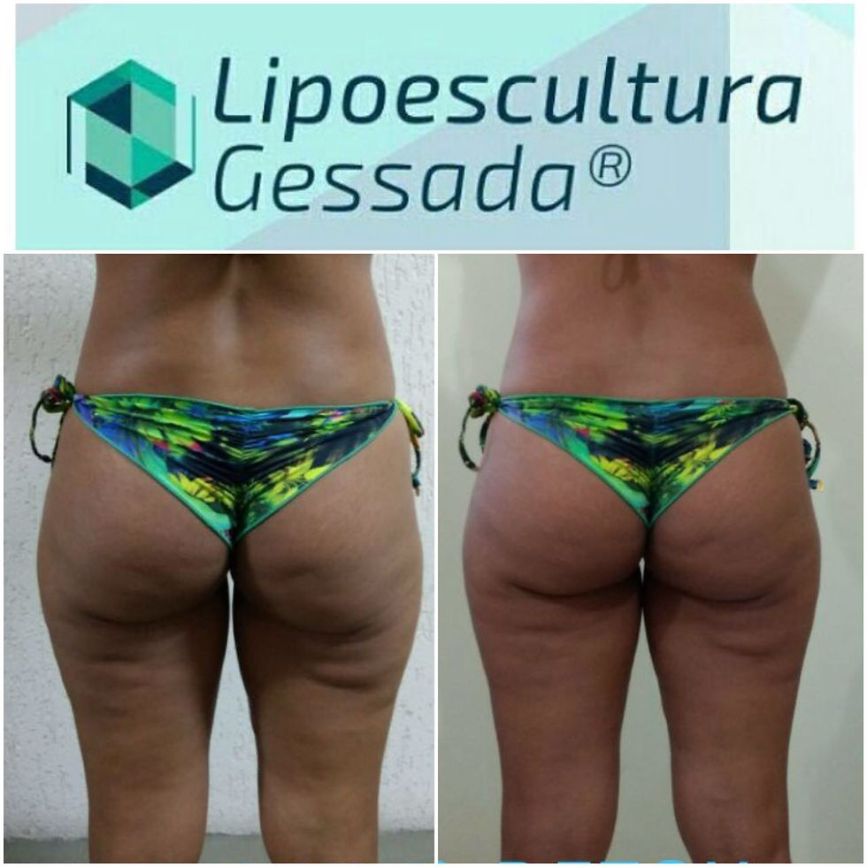 Lipoescultura Gessada
