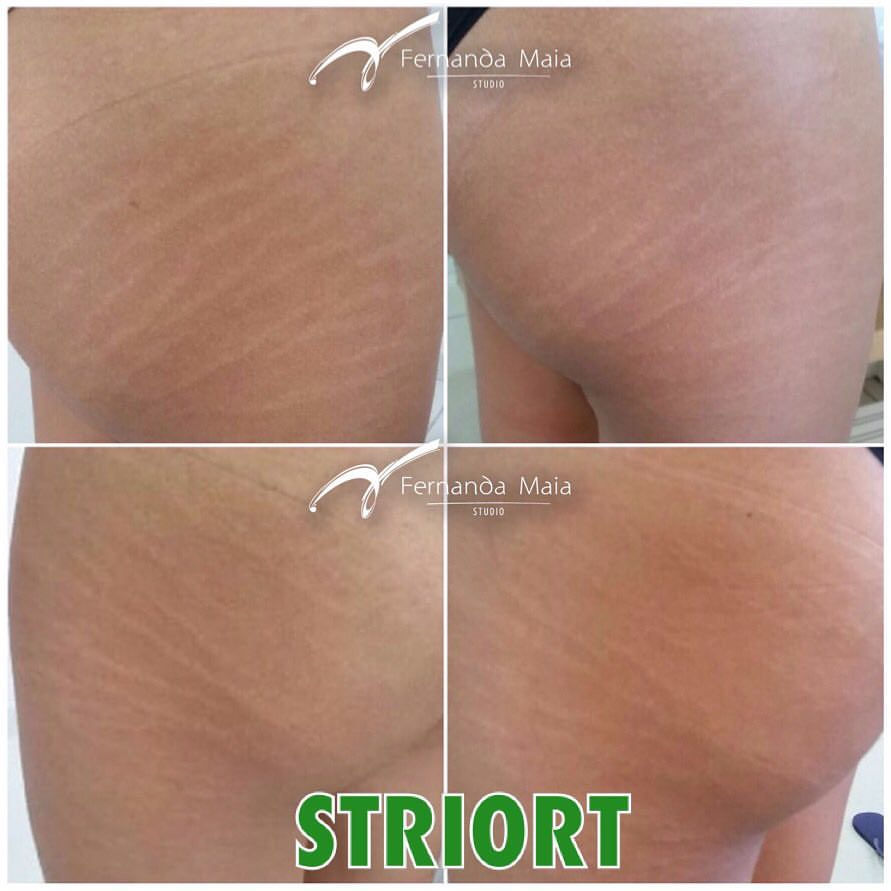 STRIORT - tratamento para estrias