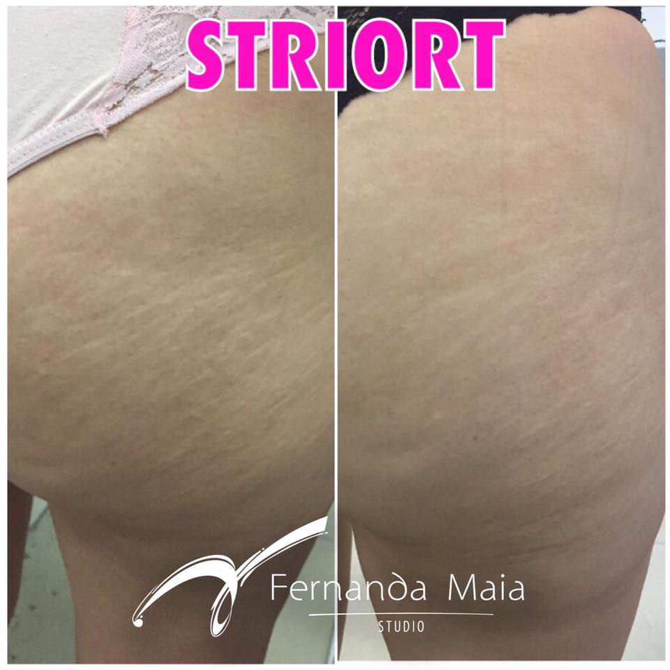 STRIORT - tratamento para estrias