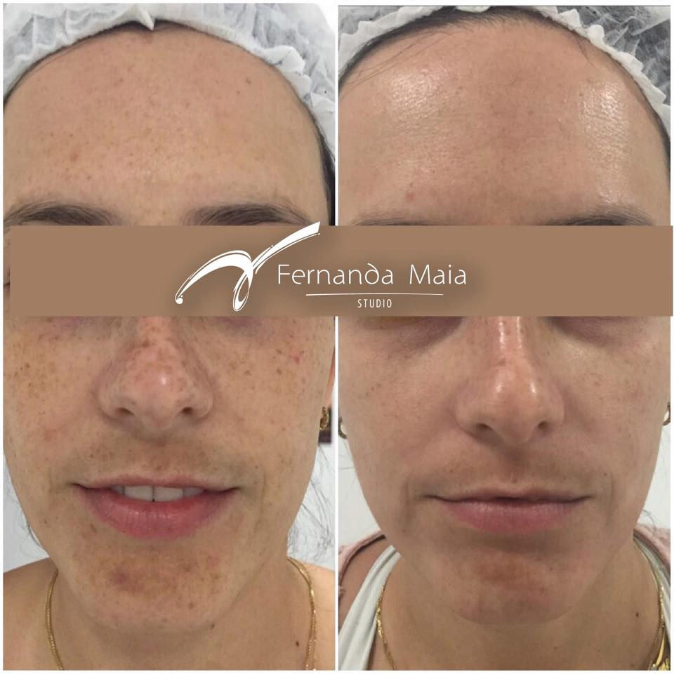 Resultado de 1 ciclo de Peeling 3D