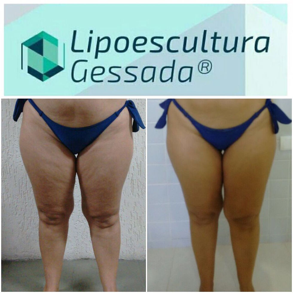Lipoescultura Gessada