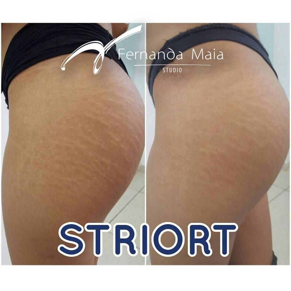 STRIORT - tratamento para estrias.