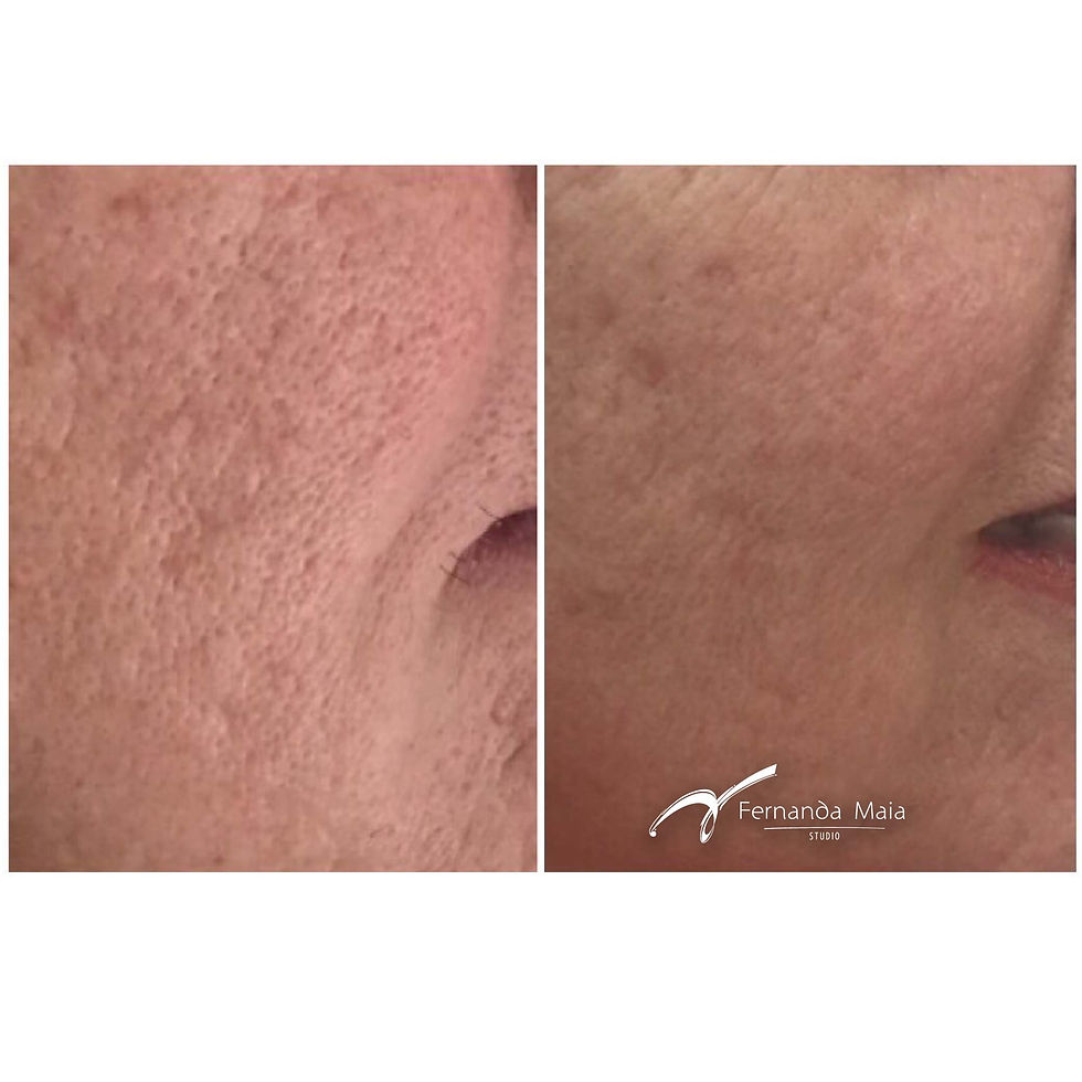 Resultado Peeling 3D