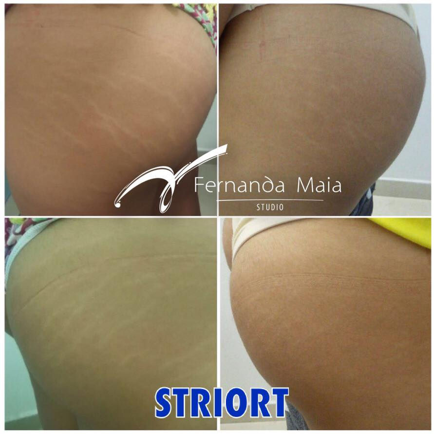 STRIORT - tratamento para estrias