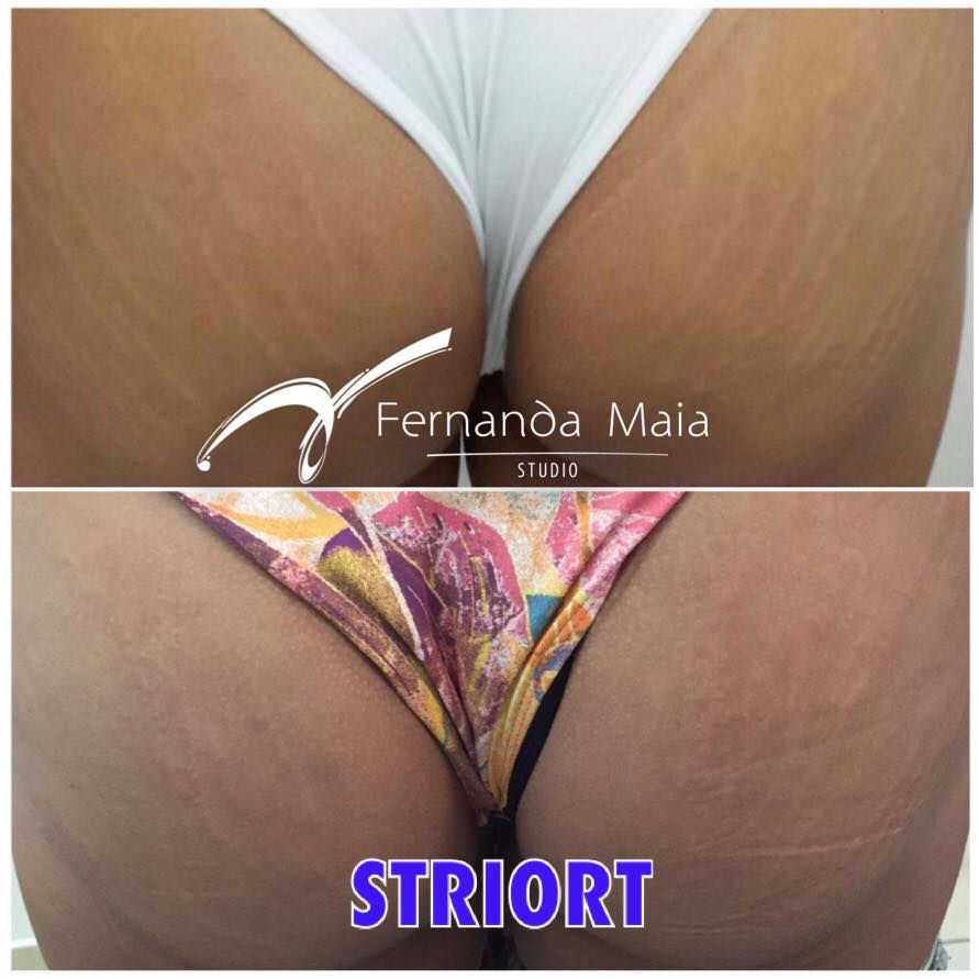 STRIORT - tratamento para estrias