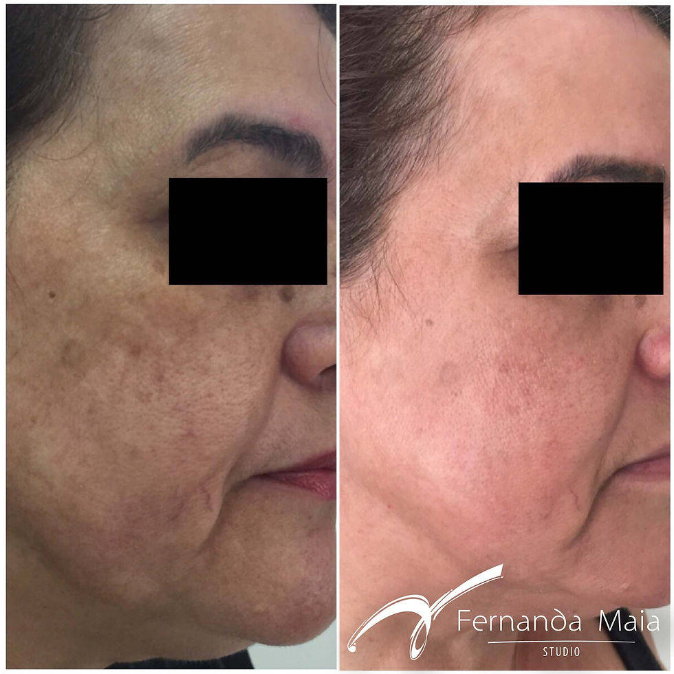 Resultado Peeling 3D