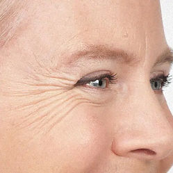 Crow’s feet anti-wrinkle Botox treatment results at Sahar Aesthetics Peterborough