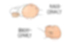 Visual comparison of normal baby head shape, plagiocephaly, and brachycephaly from above.