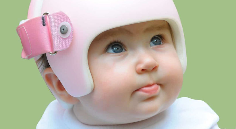 Infant wearing cranial helmet for plagiocephaly treatment 