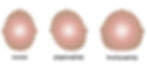 Picture of heads comparing plagiocephaly to brachycephaly and normal one.
