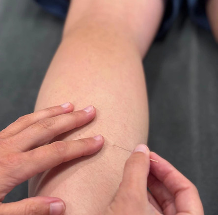MarijnVanbuel-dryneedling-Amelio
