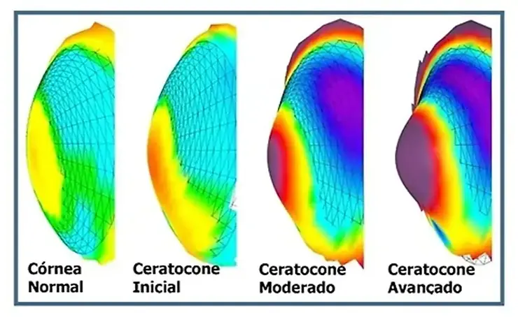 Topografia comparativa de córnea normal e Ceratocone inicial a severo