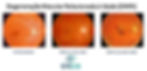 Diferença entre Retina sem alterações e com DMRI seca e úmida