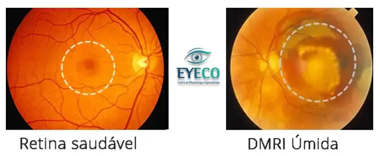 Retinografia Comparando entre Retina Normal e com Degeneração Macular Relacionada à Idade (DMRI) Úmida