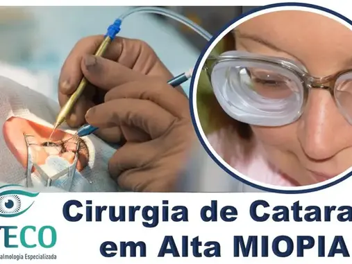 Cirurgia de Catarata em Alta Miopia com Lentes Intraoculares Premium