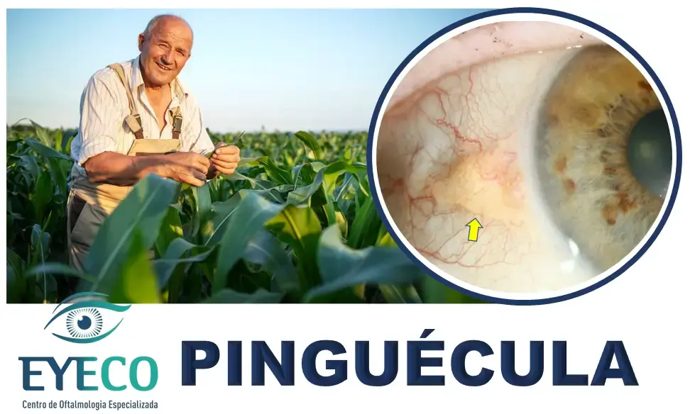 Essa manchinha amarela nos olhos pode crescer? Saiba tudo sobre a Pinguécula!