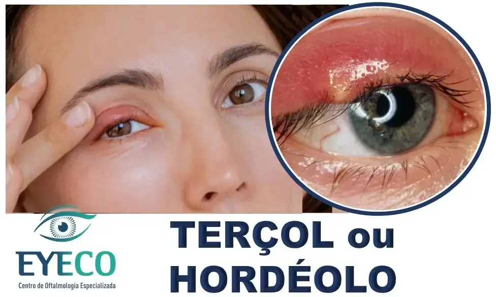 Terçol ou Hordéolo na pálpebra